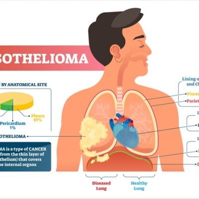 Mesothelioma – What, How &&nbsp;Why